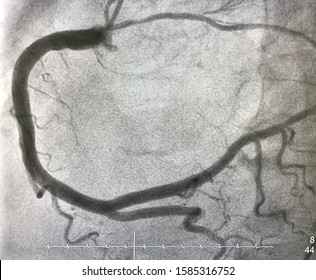 Normal Right Coronary Artery Angiogram With Collateral Branch To Left Coronary Artery.