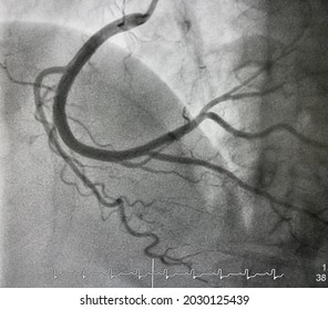 Normal Right Coronary Artery (RCA) Angiography.