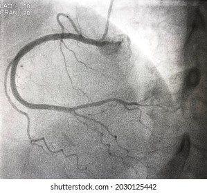 Normal Right Coronary Artery (RCA) Angiography.