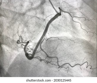 Normal Right Coronary Artery (RCA) Angiography.