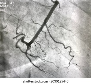 Normal Right Coronary Artery (RCA) Angiography.