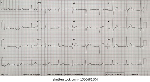 Normal Sinus Rhythm.