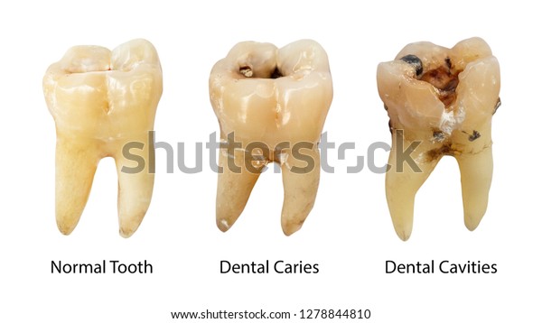 gray between front teeth calculus