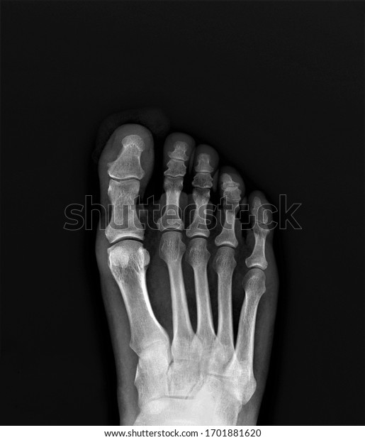 normal x-ray of the foot\
bones