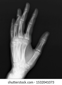 Normal Xray Hand Bones Fingers Stock Photo 1532041073 | Shutterstock