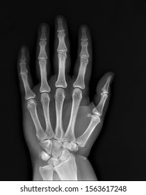 normal x-ray of the hand bones and fingers,orthopedics, medical diagnostics, rheumatology - Shutterstock ID 1563617248