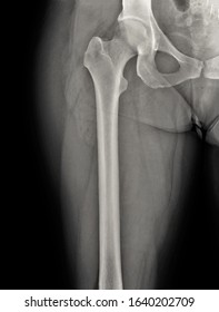 normal hip joint space xray