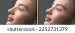Nose Before and after plastic surgery. Rhinoplasty. Crooked nose correcting. Young woman profile portrait, over grey background. Beauty female, model girl face close-up. Aesthetic medicine