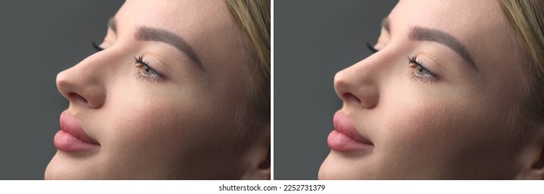 Nose Before and after plastic surgery. Rhinoplasty. Crooked nose correcting. Young woman profile portrait, over grey background. Beauty female, model girl face close-up. Aesthetic medicine - Shutterstock ID 2252731379