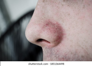 A Nose Full Of Acne And Blackheads