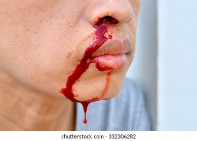 nosebleed , woman is bleeding from her nose.
