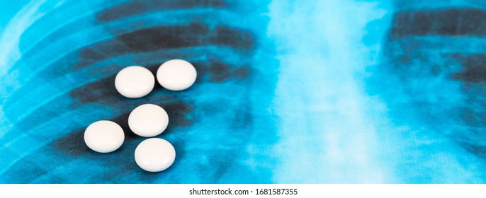 Novel Covid-19, Coronavirus. Infected Lungs Radiology Blue Image Background, With White Chloroquine Pills On It.