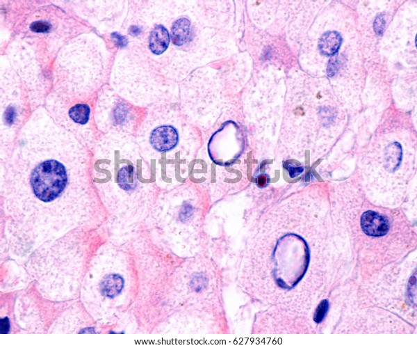 Nuclear Vacuolationglycogenation Characteristic Histological Feature ...