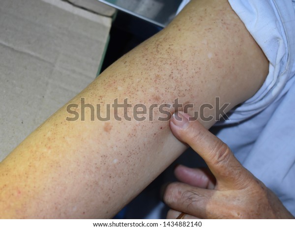 Numerous Age Spots On Arm Asian Stock Photo Edit Now