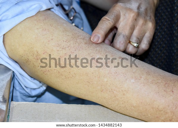 Numerous Age Spots On Arm Asian Stock Photo Edit Now