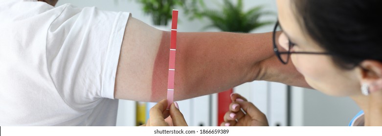 Nurse determines degree of sunburn on the arm. Medical care for burns concept - Shutterstock ID 1866659389