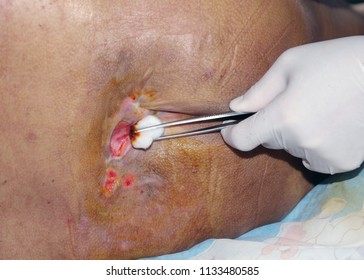 Nurse Dressing Decubitus Ulcer Or Pressure Ulcer In Patient Home.