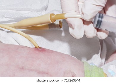 Nurse Is Feeding Through G-tube In Postoperative Period After Gastrostomy Of Newborn Baby With Esophageal Atresia In Neonatal Intensive Care Unit At Children's Hospital.