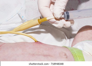 Nurse Is Feeding Through G-tube In Postoperative Period After Gastrostomy Of Newborn Baby With Esophageal Atresia In Neonatal Intensive Care Unit At Children's Hospital.