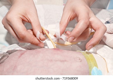 Nurse Is Fixing Gastrostomy Tube With Medical Patch In Postoperative Period Of Newborn Baby With Esophageal Atresia In Neonatal Intensive Care Unit At Children's Hospital.