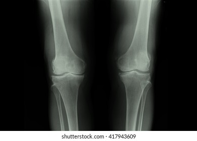 Osteoarthritis Knee Oa Knee Film Xray Stock Photo (Edit Now) 304160894