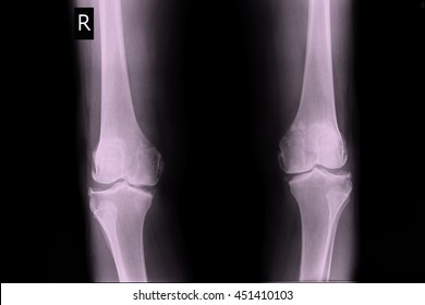 Oa Knee Stock Photo 451410103 | Shutterstock