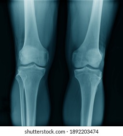 OA knee x-ray image Posteo-anterior view, OA knee diagnosis 