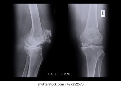 Oa Left Knee Stock Photo 427252573 | Shutterstock