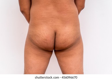 Obese Asian Male Buttocks With Cellulite And Stretch Marks