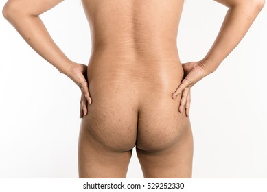 Obese Asian Male Buttocks With Cellulite And Stretch Marks