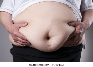 Obesity Woman Body, Fat Female Belly With A Scar From Abdominal Surgery Close Up On Gray Background