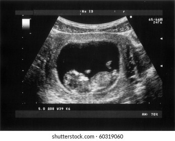 Obstetric Ultrasonography of third Month Fetus