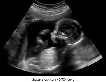 Obstetric Ultrasonography Ultrasound Echography of a fourth month fetus