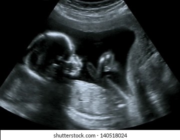 Obstetric Ultrasound of fetus at fourth month. Echography Scan.