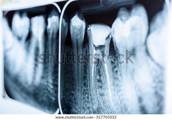 Obturation of Root\
Canal Systems On Teeth\
X-Ray