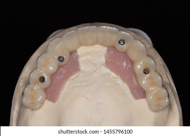 The Occlusal View Of Full Arch Full Zirconia All On Four Dental Implant Supported Bridge Displaying Screw Holes On A Stone Model With Dark Background
