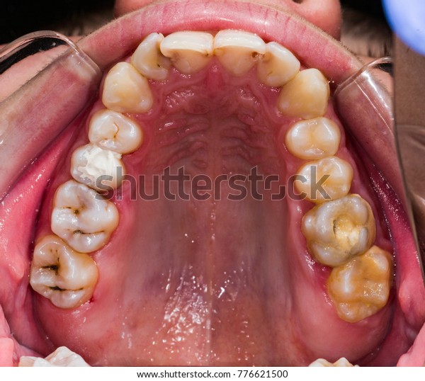 Occlusal View Human Teeth Diagnostic Problematic Stock Photo (Edit Now ...