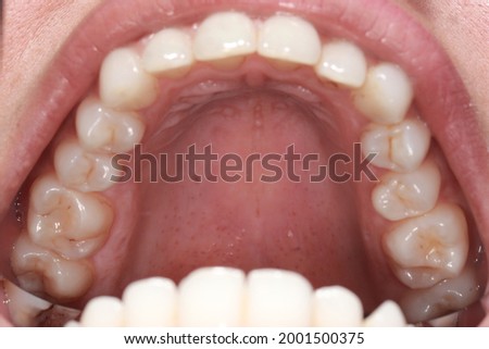 Occlusal view of upper teeth including centrals, laterals, canines, premolars and molars. floor of the mouth can be seen and alignment of teeth can be observed.