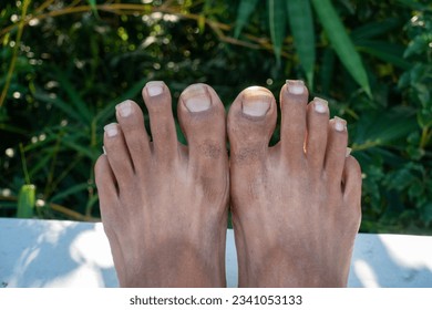 Oct.14th 2022 Uttarakhand, India. Neglected foot nails of an Indian adult with unhygienic feet conditions. Concept of self-care and personal hygiene.