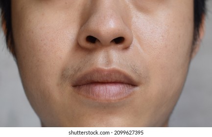 Oily Face Of Southeast Asian, Myanmar Or Korean Adult Young Man.