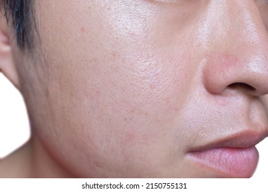 Oily Face Of Southeast Asian, Myanmar Or Korean Adult Young Man.