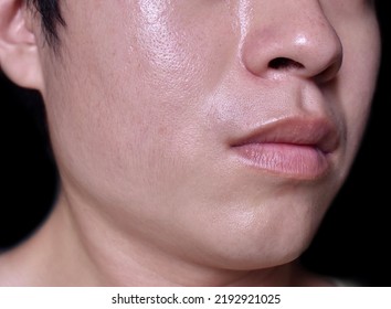 Oily Face Of Southeast Asian, Myanmar Or Korean Adult Young Man.