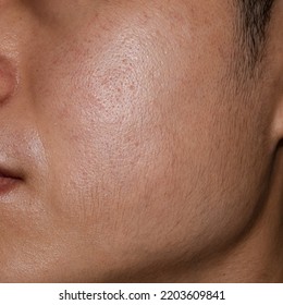 Oily Face With Wide Pores Of Southeast Asian, Myanmar Or Korean Adult Young Man.