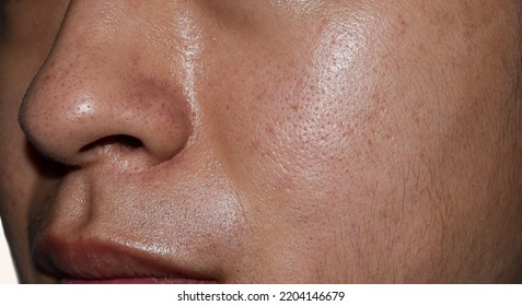 Oily Face With Wide Pores Of Southeast Asian, Myanmar Or Korean Adult Young Man.