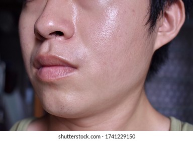 Oily and fair skin, wide pores of Southeast Asian, Myanmar or Chinese adult young man. Oily skin is the result of the overproduction of sebum from sebaceous glands.