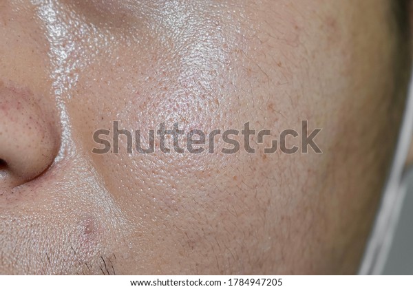 Oily and fair skin, wide\
pores of Southeast Asian, Myanmar or Korean adult young man. Oily\
skin is the result of the overproduction of sebum from sebaceous\
glands.