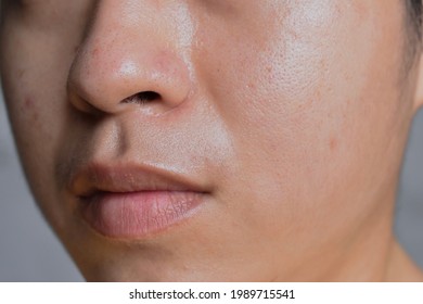 Oily skin with wide pores in face of Southeast Asian, Myanmar or Korean adult young man. Closeup view.
