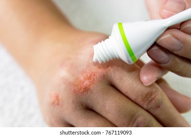 Ointment On Hand. Applying The Ointment In The Treatment And Hydration Of The Skin. 