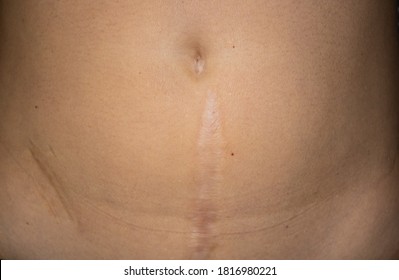 Old abdominal scar from surgery. Big scar. Surgical scars.