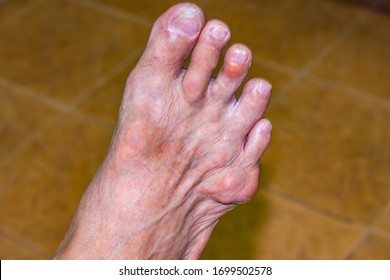 Old age and illnesses of pharmaceutical medicament severe gout in men suffering from joint pain, bone pain, gout ,arthritis ,arm, foot, knee, rheumatoid symptoms, Concept of abstract pain and despair.